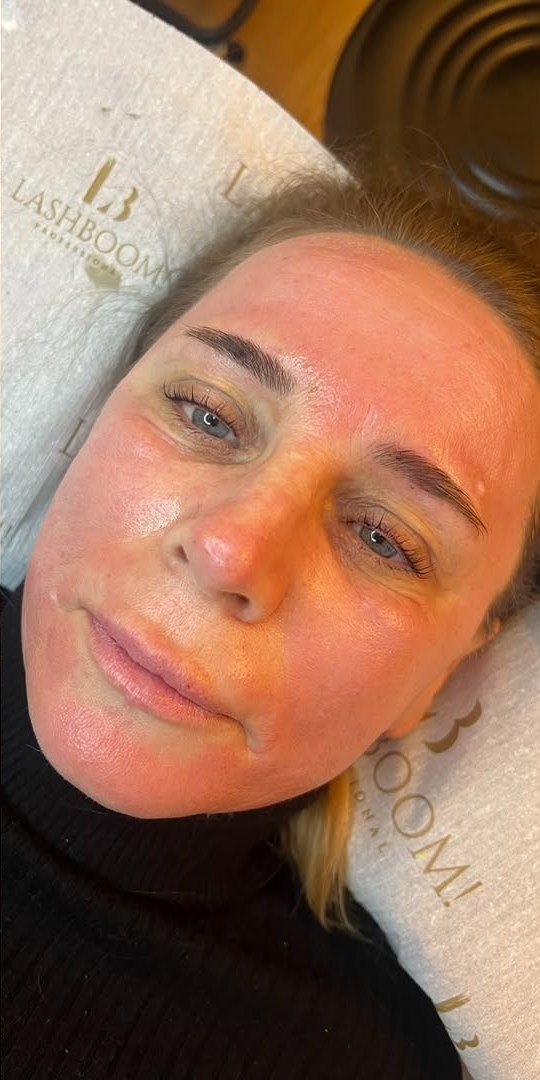Nachher: Haut nach Microneedling, Brauen und Lashlifting