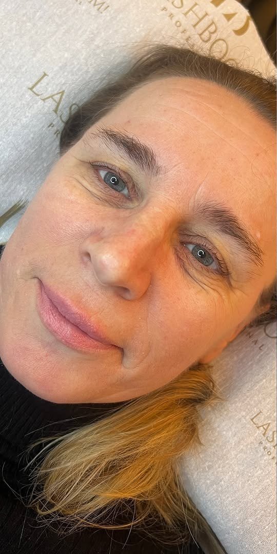 Vorher: Haut vor dem Microneedling
